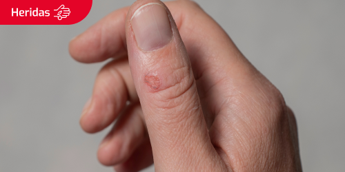 Dedo con una herida que supura líquido. Se lee el texto “Heridas” en un recuadro