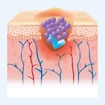 Illustration of a local infection.