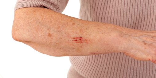 Protezione delle ferite e della pelle (se non è necessario un prodotto assorbente) con Leukomed® T Skin Sensitive