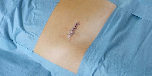 Medicazione di incisioni chirurgiche con Leukomed® T Plus Skin Sensitive