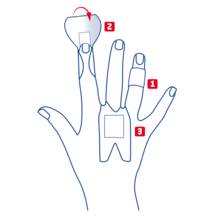 Overview of finger strip variants for knuckles, phalanx and fingertip