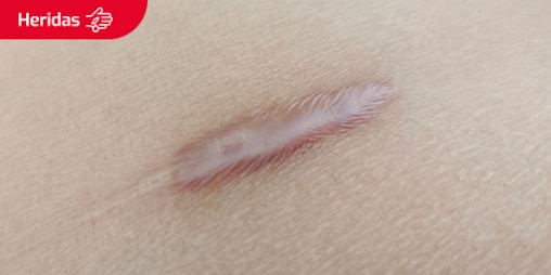 Primer plano de un corte que ha cicatrizado y formado una cicatriz queloide. Se lee el texto “Heridas” dentro de un recuadro.
