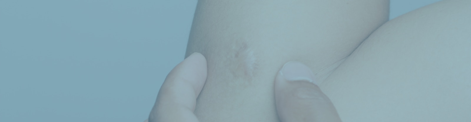 Persona con una cicatriz queloide en el brazo bajo el título “Cómo prevenir la aparición de una cicatriz queloide”.
