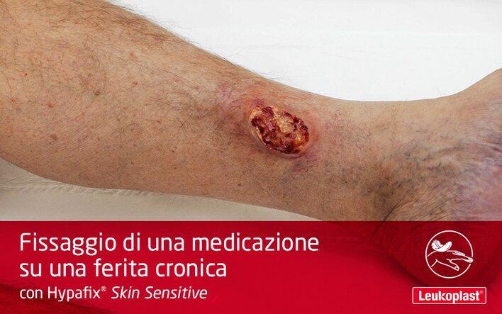 In questo video impariamo come usare Hypafix Skin Sensitive per il trattamento di un'ulcera su una gamba. Possiamo vedere come un operatore sanitario fissa una medicazione sull'ulcera situata sulla gamba del paziente. 
