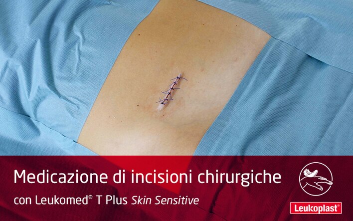 Questo video mostra come proteggere le incisioni chirurgiche sulla pelle fragile con Leukomed T Plus Skin Sensitive: vediamo un operatore sanitario coprire una ferita post-operatoria sull'addome di un paziente.