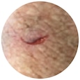 Type 1 skin tear: linear or flap tear where the skin flap can be repositioned to cover the wound bed.