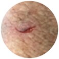 Type 1 skin tear: lineær skin tear eller skin tear med hudlap, hvor huden kan repositioneres, så den dækker sårbunden. 