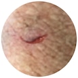 Desgarro cutáneo de tipo 1: desgarro plano o lineal, en el que el colgajo de piel puede recolocarse para cubrir el lecho de la herida. 