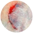 Type 2-huidbeschadiging: de huidflap kan niet worden verplaatst om het hele wondbed te bedekken. 