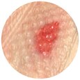 Type 3 skin tear: Komplet tab af lap, der blotter hele sårbunden. 