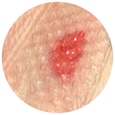 Type 3-huidbeschadiging: volledig verlies van huidflap dat het hele wondbed blootlegt. 