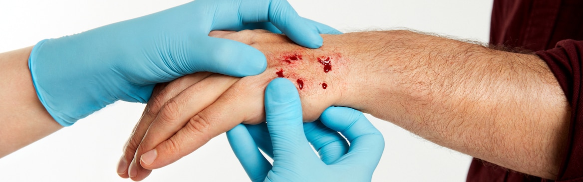 Experto médico sujetando la mano de un hombre herido con un mordisco.