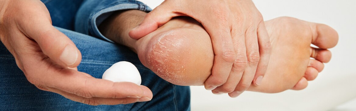 Man with cracked skin applies Leukoplast Cutimed acute mousse on his heel.