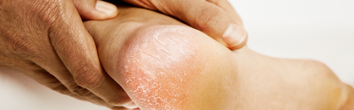 Man with cracked skin applies Leukoplast Cutimed acute mousse on his heel.