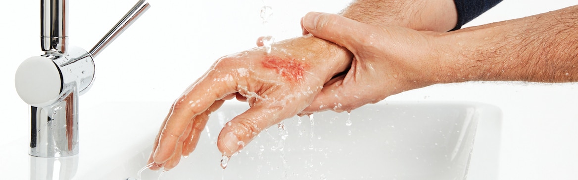 Muž si chladí popáleniny prvního stupně na prstech tekoucí vodou z kohoutku.