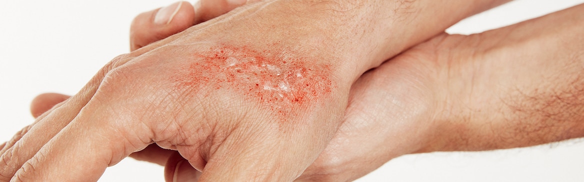 Man cooling a first degree burn on fingers with running tap water.