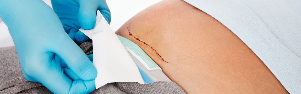Expert médical appliquant un pansement Leukomed Sorbact de Leukoplast sur une plaie résultant de l’incision d’une césarienne.