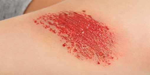 Tampak dekat dari luka lecet atau abrasi yang memerah pada kulit yang terang.