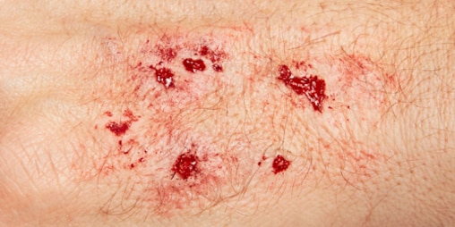 Detailný záber kože zobrazujúci penetračnú ranu alebo ranu po uhryznutí.