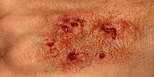 A close-up of skin showing penetration or bite wound.