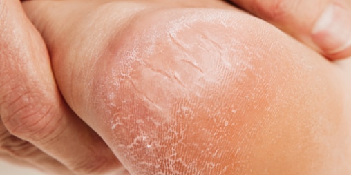 Gros plan de la peau calleuse d’un talon avec fissures ou crevasses profondes.