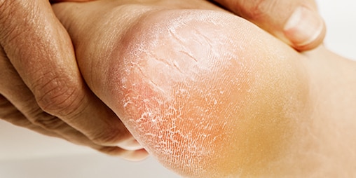 Close-up of callous heel with deep fissures or cracks.