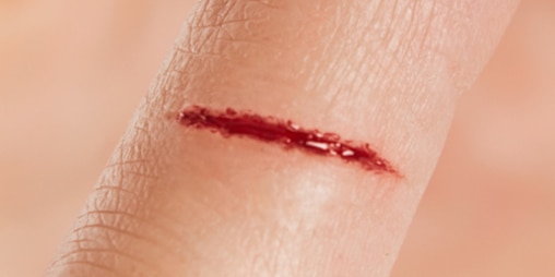 Close-up van een vingertop met een snijwond.