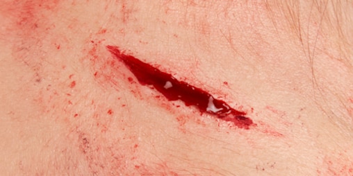 Close-up of forehead or temple with gaping laceration.