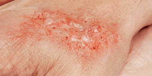 Een close-upfoto van een lichte brandwond en een rode, blaarvormige huid.