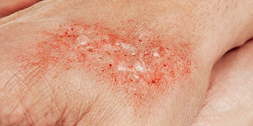 A close-up picture showing a minor burn and reddened, blistering skin.