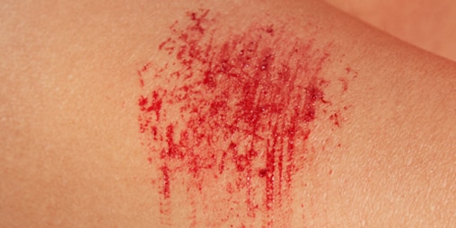 Tampak dekat dari luka gores berwarna merah pada kulit yang terang.