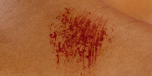 Close-up photo of red scratches on fair skin.