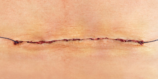 Detailní záběr uzavřené chirurgické rány neboli řezu se stehy.