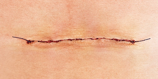 Close-up of a closed surgical wound or incision with stiches.