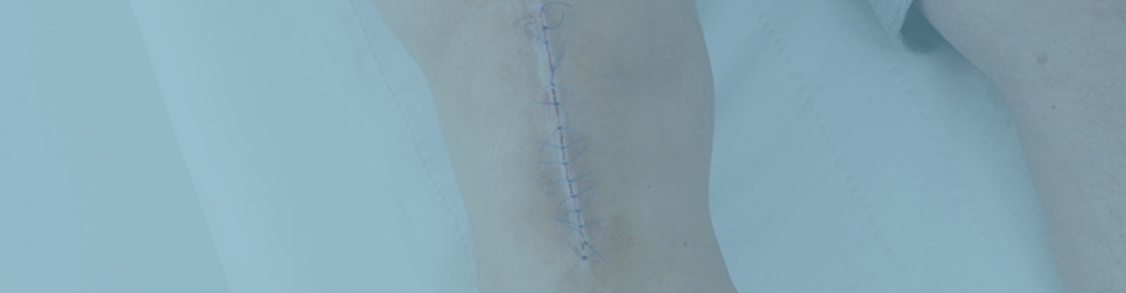 Imagen de una herida con puntos cicatrizando