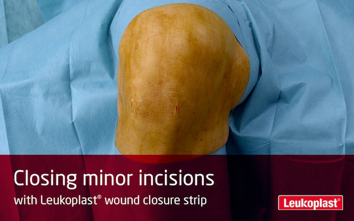 This video shows how to treat cut wounds with Leukoplast wound closure strip: we see the hands of an HCP using wound closure strips to close two minor incisions on a knee.