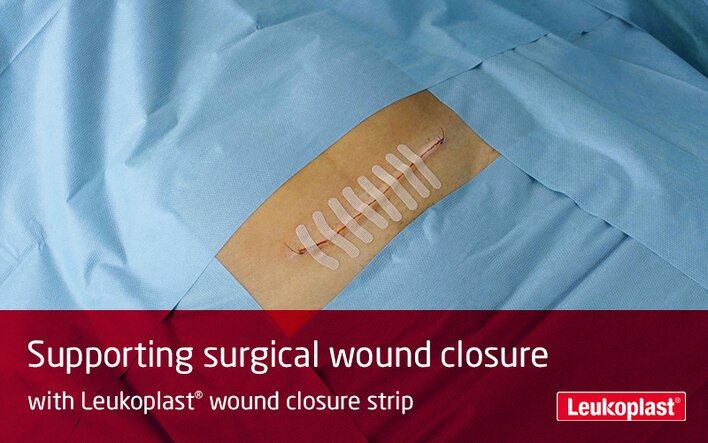 Hier wird gezeigt, wie Leukoplast wound closure strip nach einem Kaiserschnitt verwendet werden: Zu sehen sind die Hände einer medizinischen Fachkraft, die eine Kaiserschnittwunde mithilfe von Wundnahtstreifen verschliesst. 