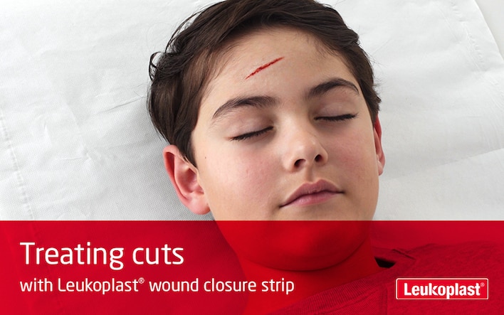 The video shows how cut wounds can be closed using wound closure strips: we see an HCP treating a cut on a boy's forehead with the help of Leukoplast wound closure strip.