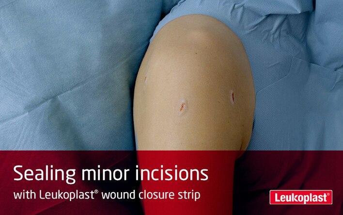 Here we can see in a close-up how minor incisions are treated using wound closure strips: we see an HCP sealing three small cut wounds on a patient's shoulder with the help of Leukoplast wound closure strip.