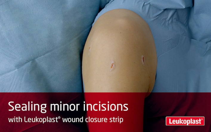 Deze video laat zien hoe incisies met Leukoplast wound closure strip kunnen worden behandeld: we zien de handen van een zorgprofessional die twee kleine incisies in een knie sluiten.