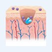 cutimed_website_wound-management_DiabeticFootUlcer_1_Contaminated wound_280x280.jpg cutimed_website_wound-management_DiabeticFootUlcer_1_Contaminated wound_280x280.jpg