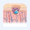 cutimed_website_wound-management_DiabeticFootUlcer_2_Colonized wound_280x280.jpg cutimed_website_wound-management_DiabeticFootUlcer_2_Colonized wound_280x280.jpg