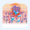 cutimed_website_wound-management_DiabeticFootUlcer_4_Spreading infection_280x280.jpg cutimed_website_wound-management_DiabeticFootUlcer_4_Spreading infection_280x280.jpg