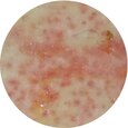 voorbeeld Folliculitis