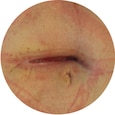 voorbeeld dermatitis
