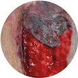 voorbeeld skin tear