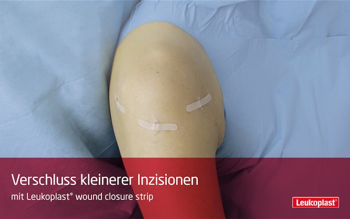In diesem Close-Up-Video sehen Sie, wie kleine Inzisionen mit Hilfe der Wundnahstreifen behandelt werden können: Das Fachpersonal verschließt drei kleine Schnittverletzungen auf der Schulter des Patienten mit Leukoplast® wound closure strip.