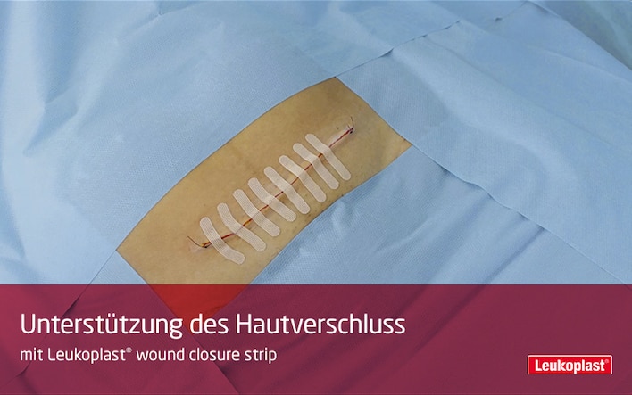 Hier zien we hoe Leukoplast wound closure strip kan worden gebruikt na een keizersnede: We zien de handen van een zorgprofessional een wondsluiting uitvoeren na een keizersnede.