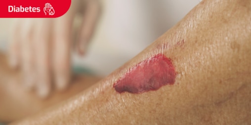 Imagen de una herida en la piel