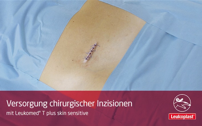 Dieses Video zeigt, wie chirurgische Inzisionen auf fragiler Haut mit Leukomed® T plus skin sensitive geschützt werden können: Das Fachpersonal deckt die post-operative Wunde auf dem Bauch des Patienten ab.